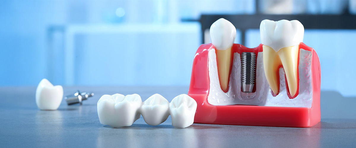 Implantes Dentales vs Puentes