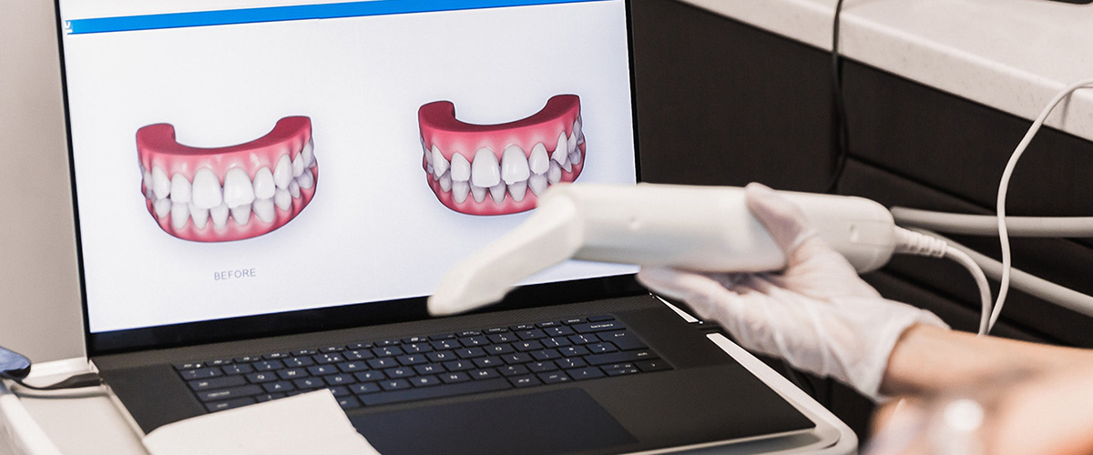 ¿Qué es el Diseño Digital de Sonrisa? Qué Esperar y Cómo Funciona