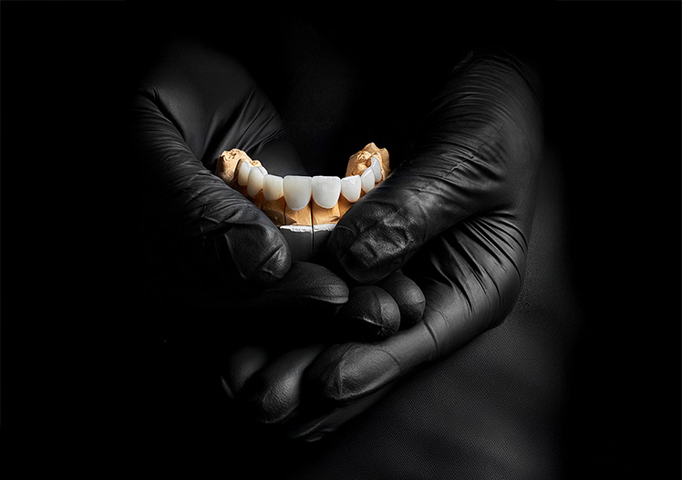 Composite Veneers vs. Injected Resin Veneers: Dentist-Approved Comparison