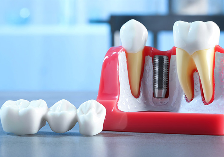 Implantes Dentales vs Puentes