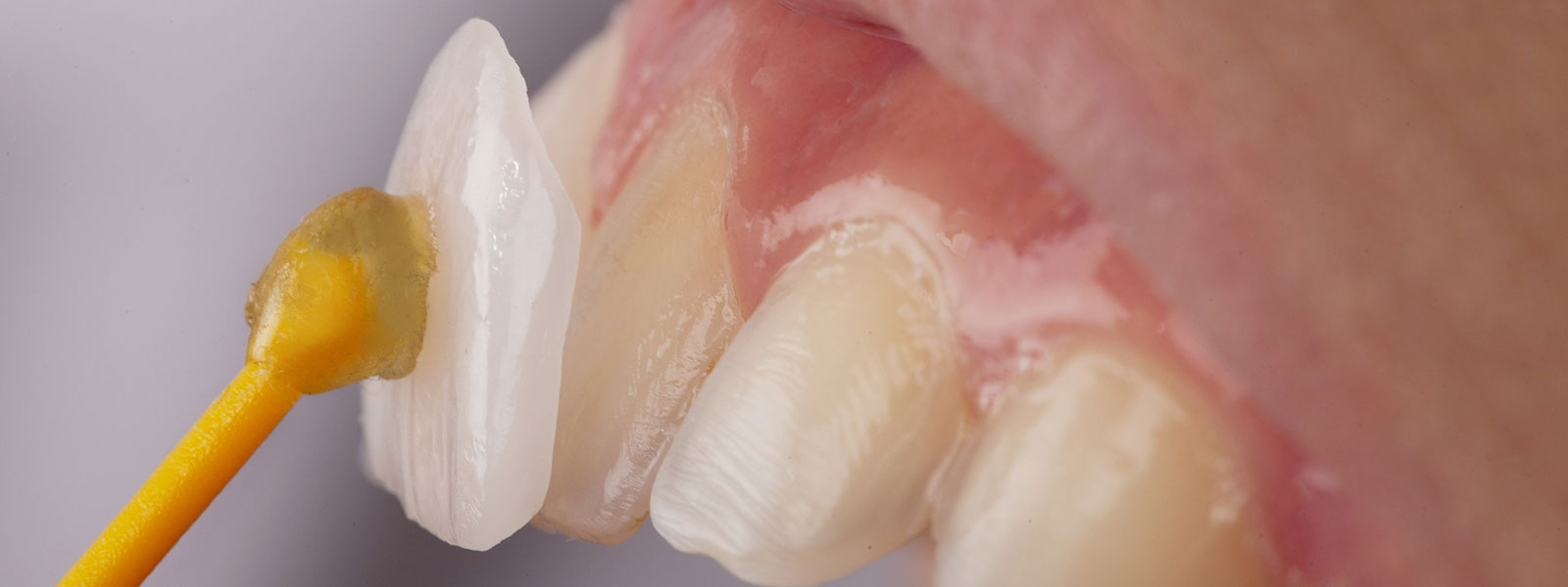 smile design mistakes