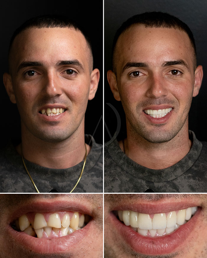 Diseño de sonrisa del paciente 10 en Miami: fotos de antes y después.