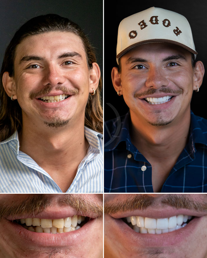 Diseño de sonrisa antes después de verdadero paciente