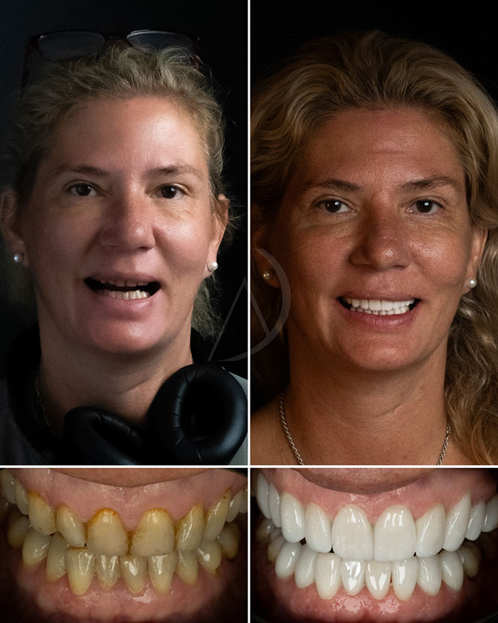 Paciente 4: Transformación de sonrisa en Miami