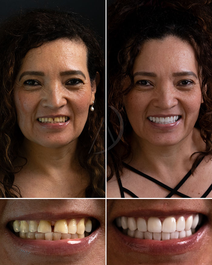 patient 6 smile makeover before after