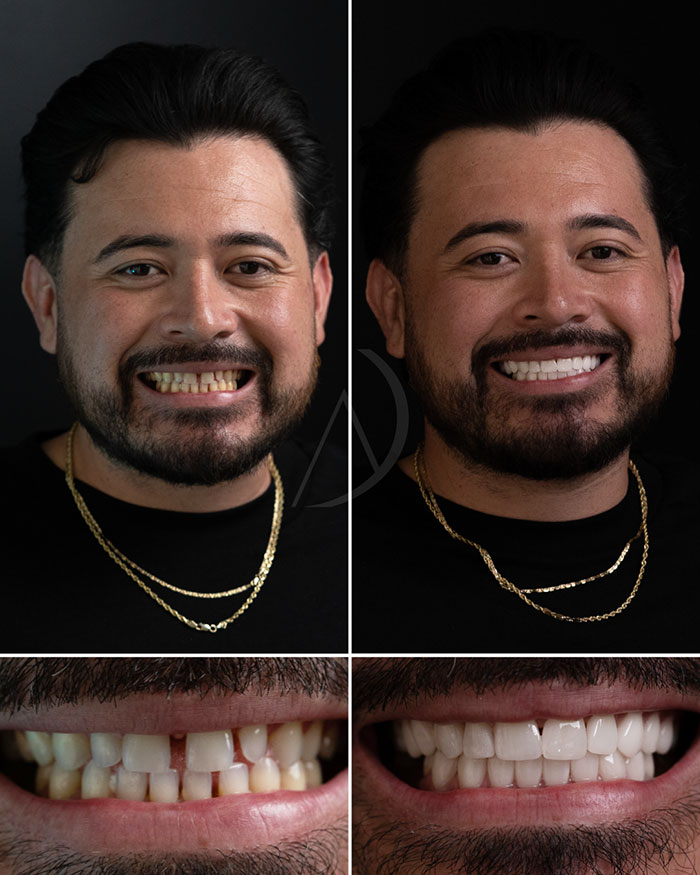 Paciente 7: Fotos de antes y después del cambio de imagen de la sonrisa.