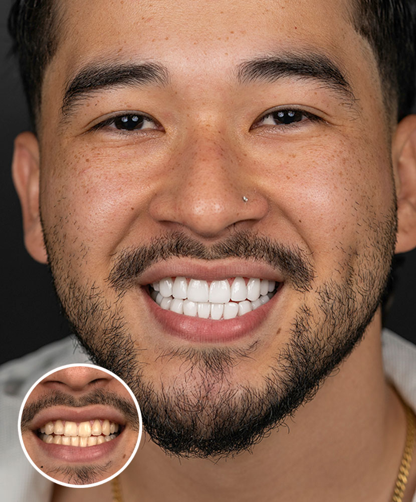 Composite Veneers in Miami