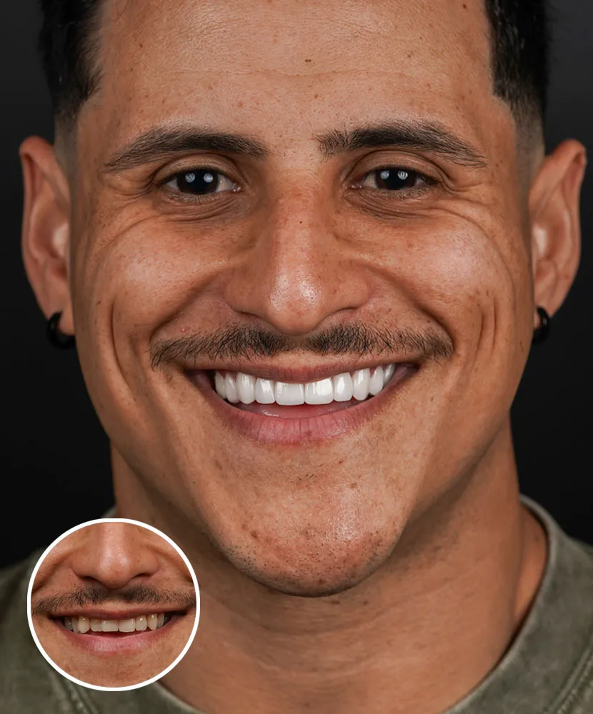 Lumineers® Veneers in Miami