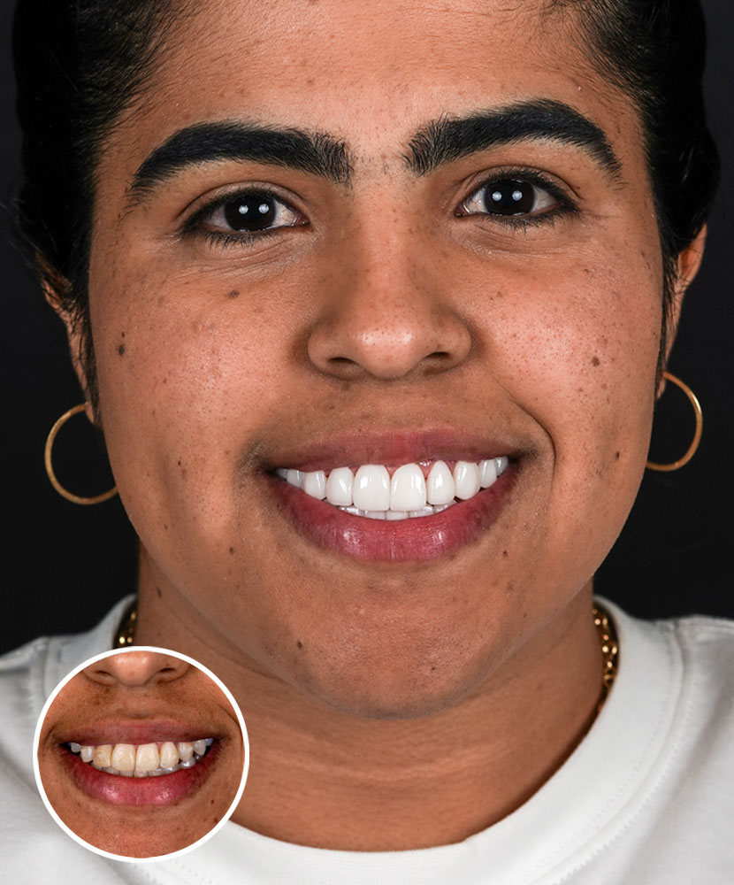 Porcelain Veneers Miami