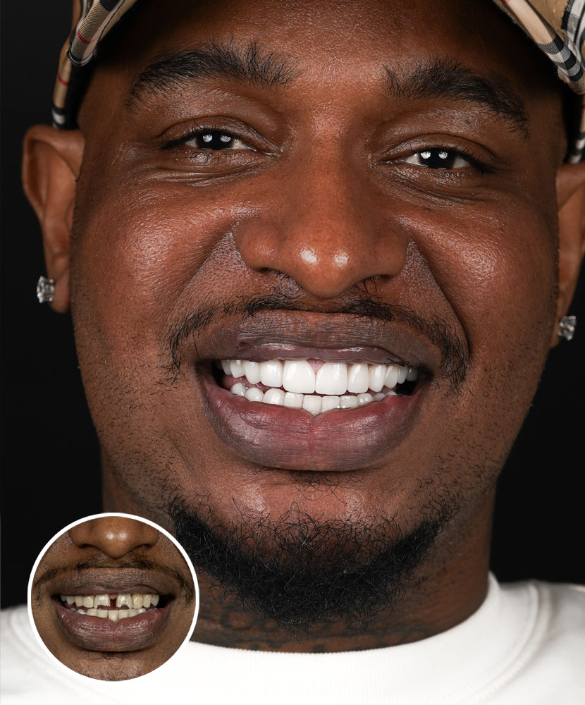 Teeth Bonding in Miami