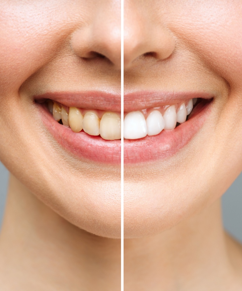 Professional Teeth Whitening in Miami
