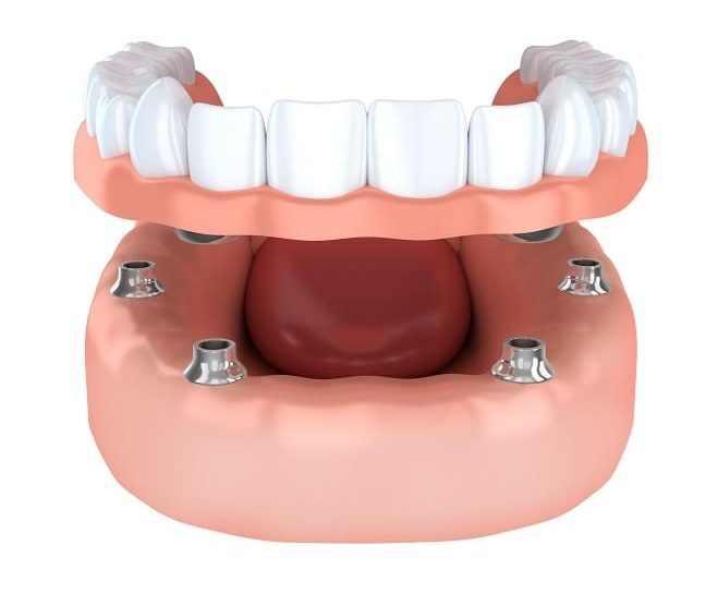 Dentadura o Protesis dental sobre implantes