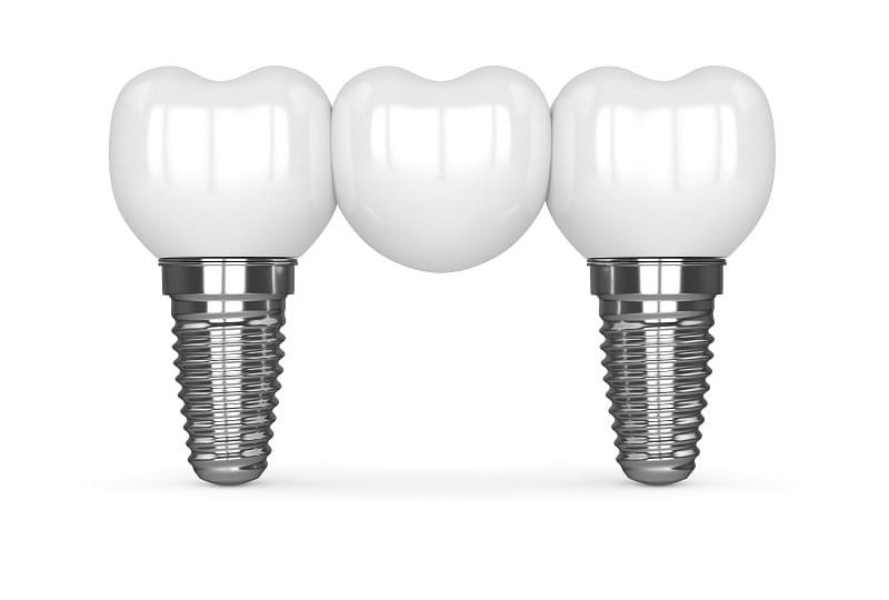 Implant supported bridge