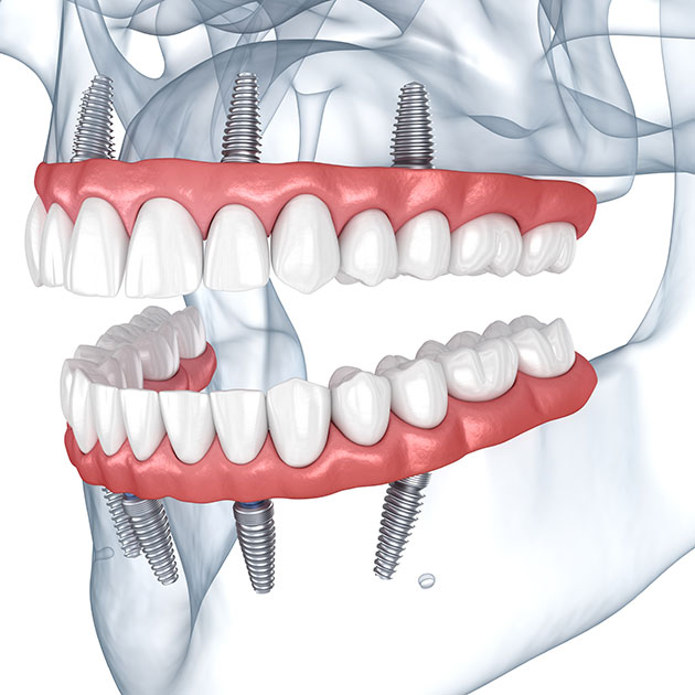 all-on-4 dental-implants upper and lower arch