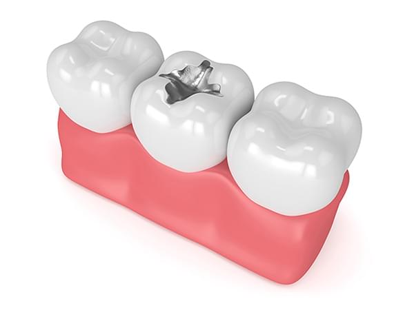 amalgams metal fillings