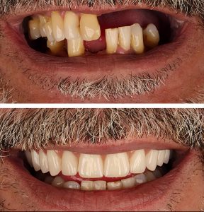 before and after of real patient