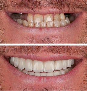 all-on-4 treatment patient before and after