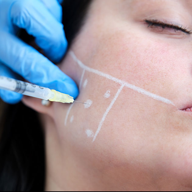 Botox Application Sites for Bruxism Treatment at our clinic