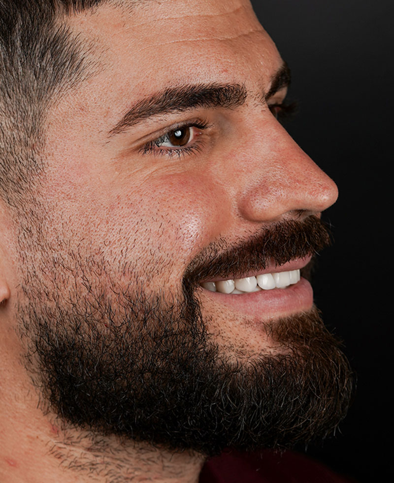 Diseño de sonrisa del paciente Carlos en Aria