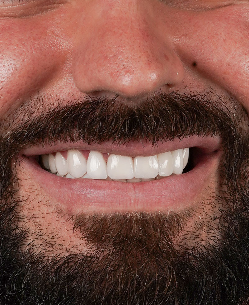 carlos Diseño de sonrisa foto del Despues