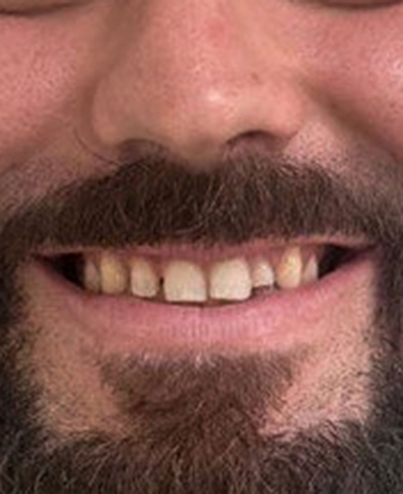 carlos Diseño de sonrisa foto del antes