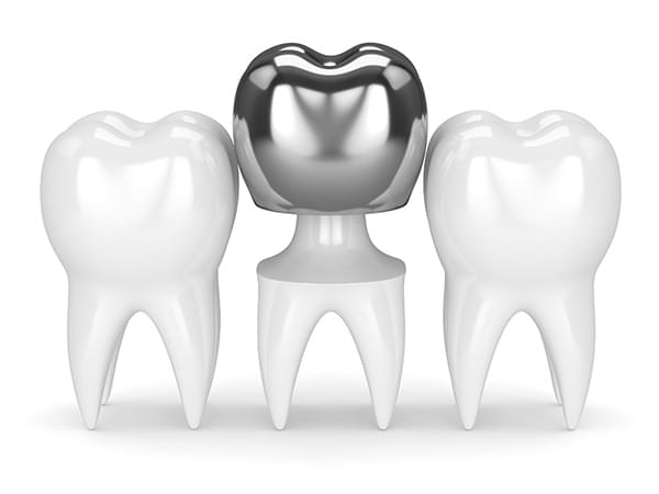 metal crowns