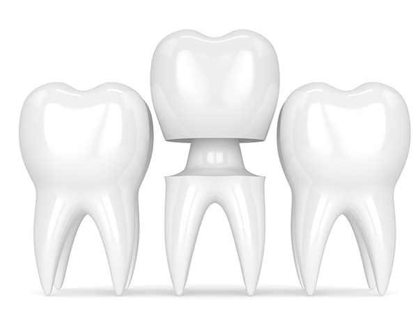 Corona dental de Resina compuesta