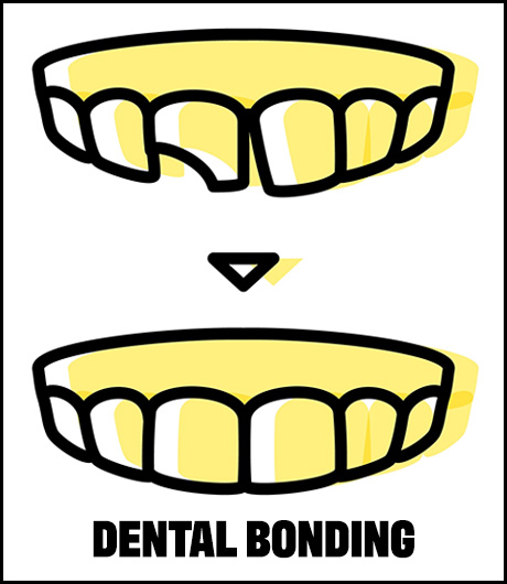 dental bonding procedure