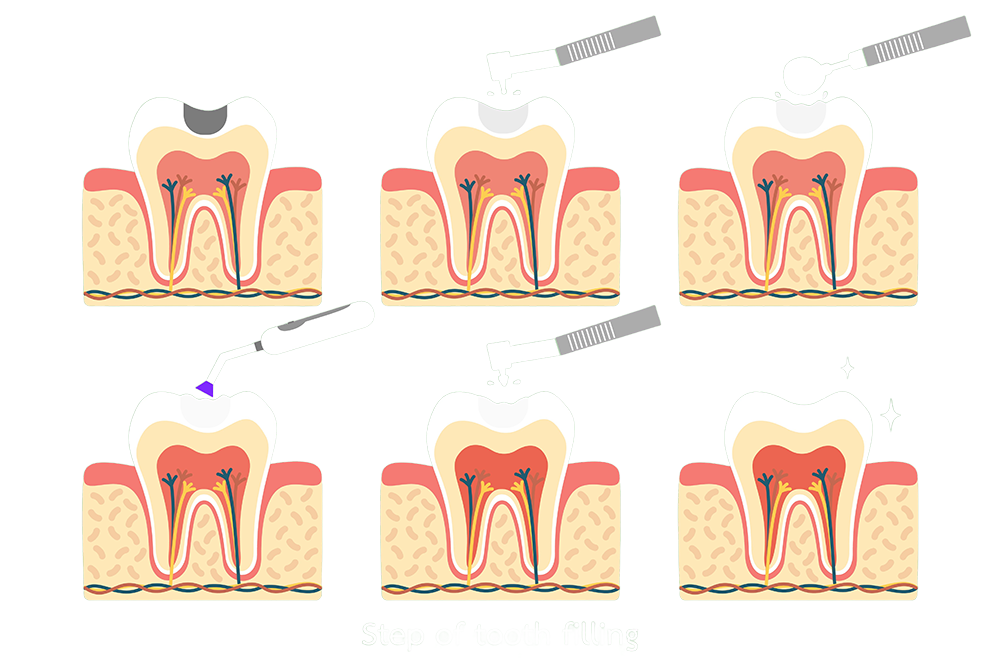 Infografía que muestra el proceso paso a paso de un empaste dental, desde la preparación del diente hasta la restauración final