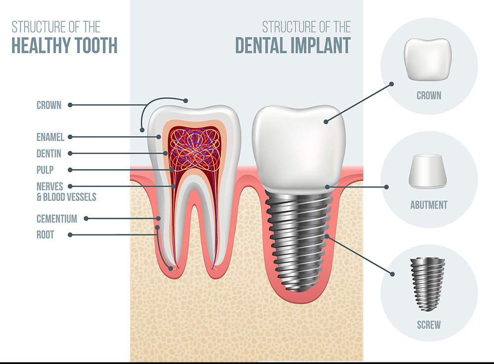 dental implant structure