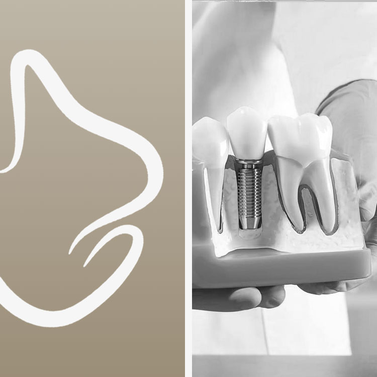 Tratamiento de Implantes dentales en Miami