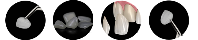 ultra thin veneers