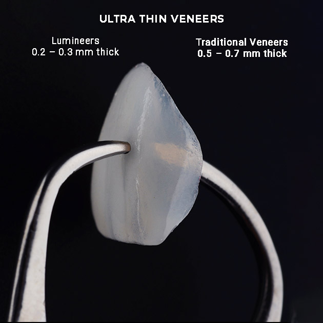 luminneers ultra thin veneer 2