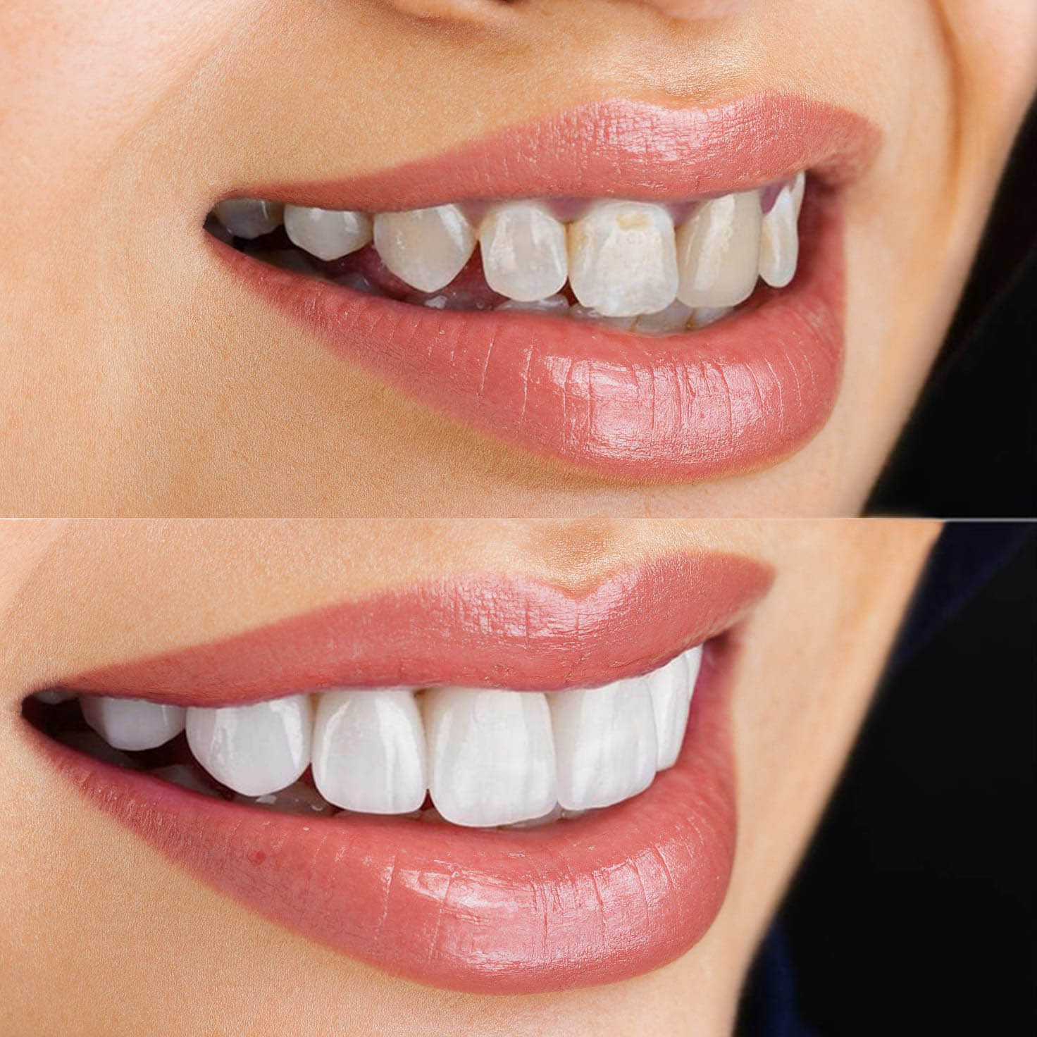 Lumineers veneers before and after
