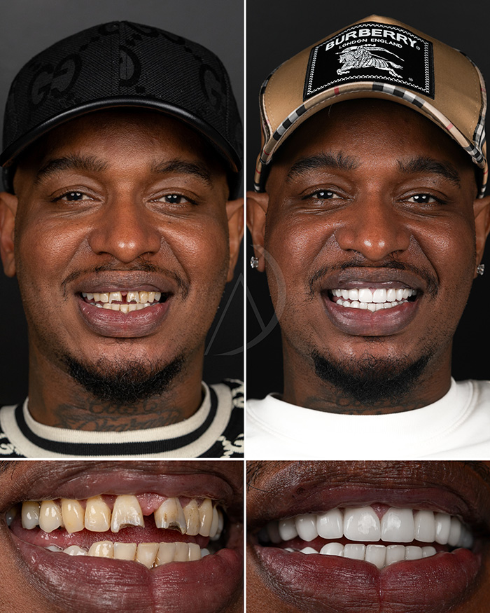 smile design with porcelain veneers before after