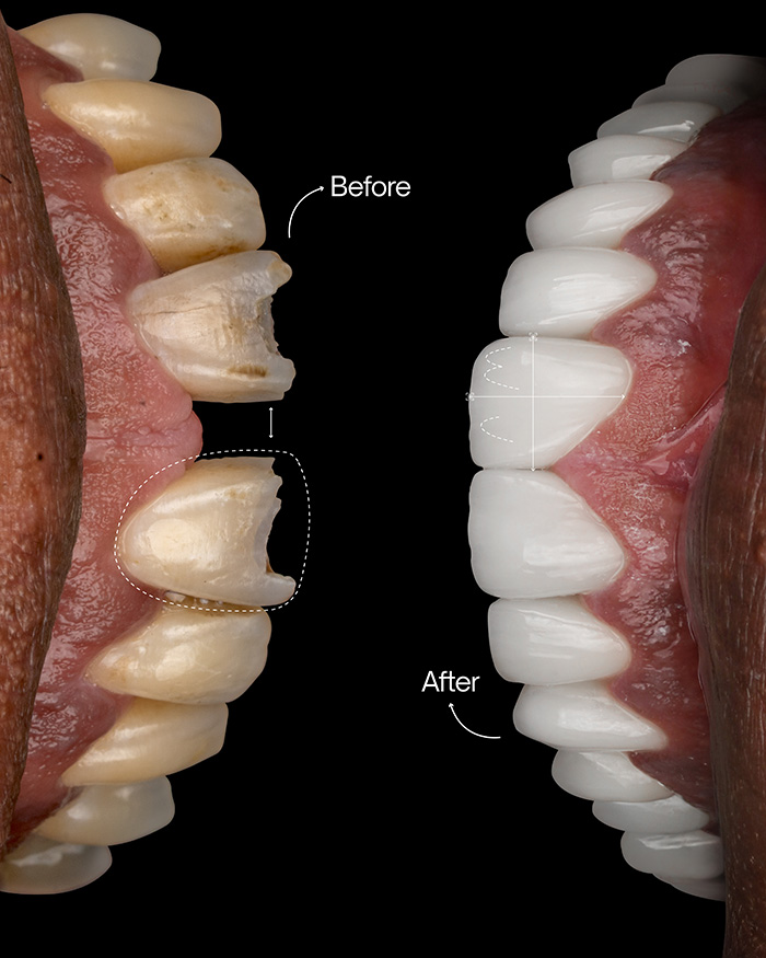 Foto del antes y despues de la transformacion de sonrisa de Mark arco superior