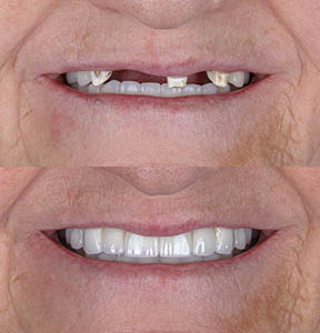 mouth rehabilitation with implants
