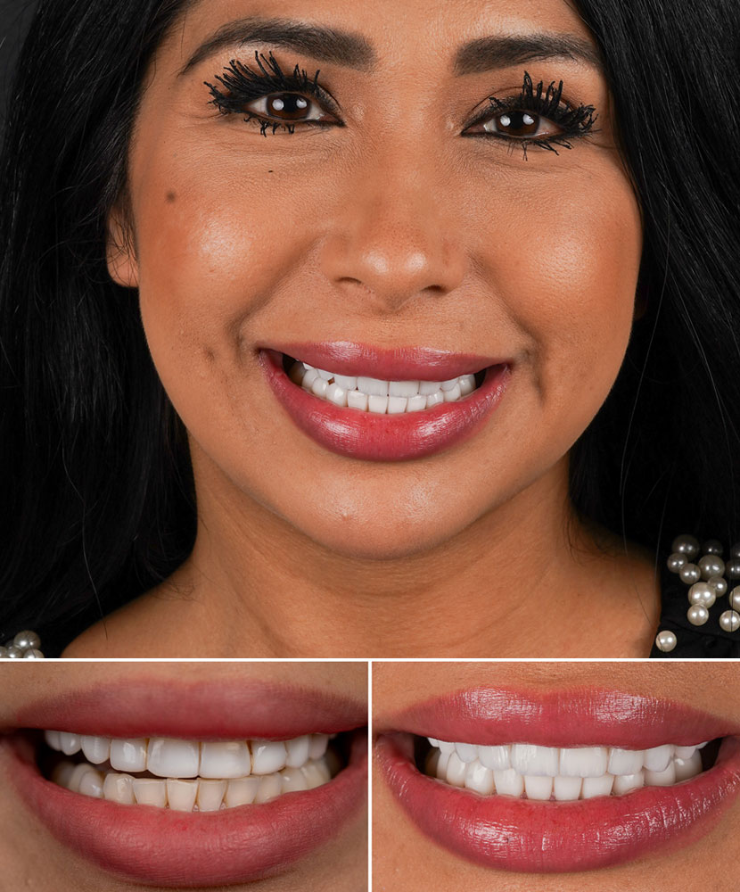 paciente femenina que recibio carillas de porcelana en nuestra clinica de miami