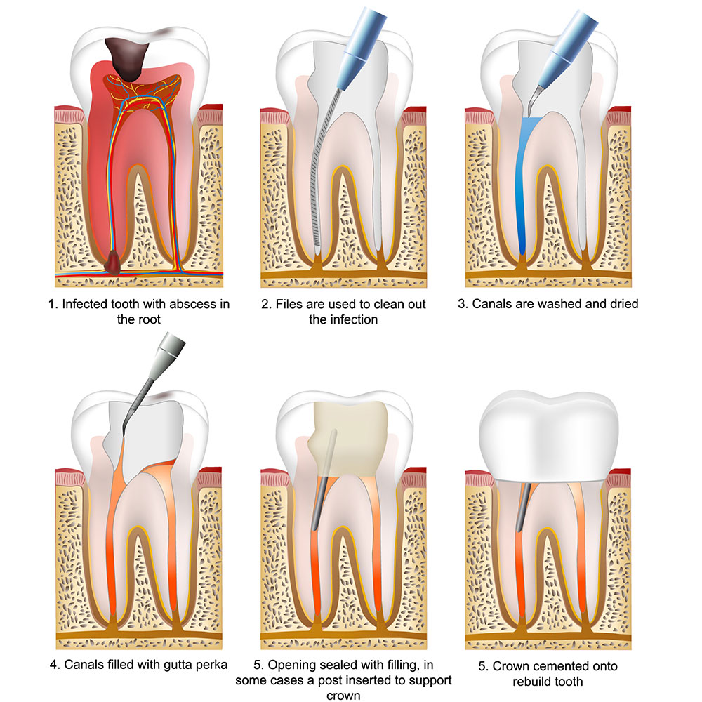 Step-by-step illustration explaining the root canal procedure, including cleaning, disinfection, and sealing of the tooth
