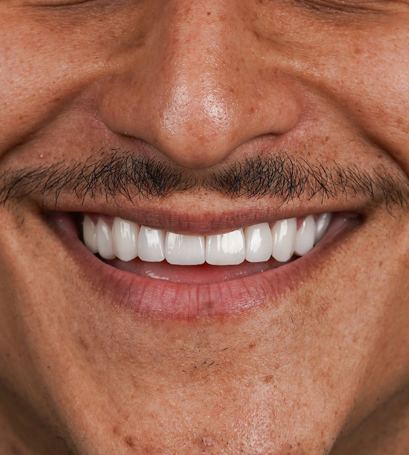 Veneers after