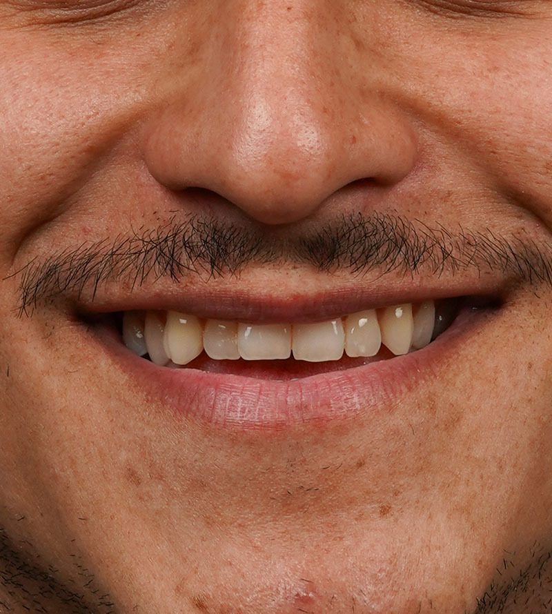 Veneers before