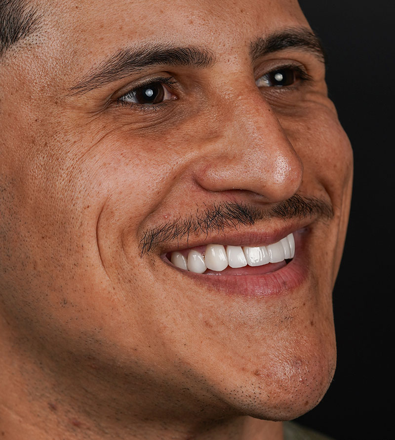 Real Patient treated with Venners at our Clinic in Miami