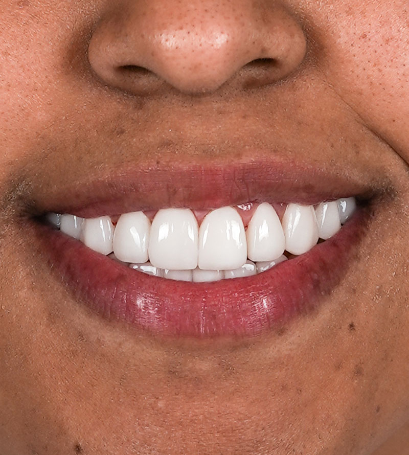 yeranis porcelain smile design after