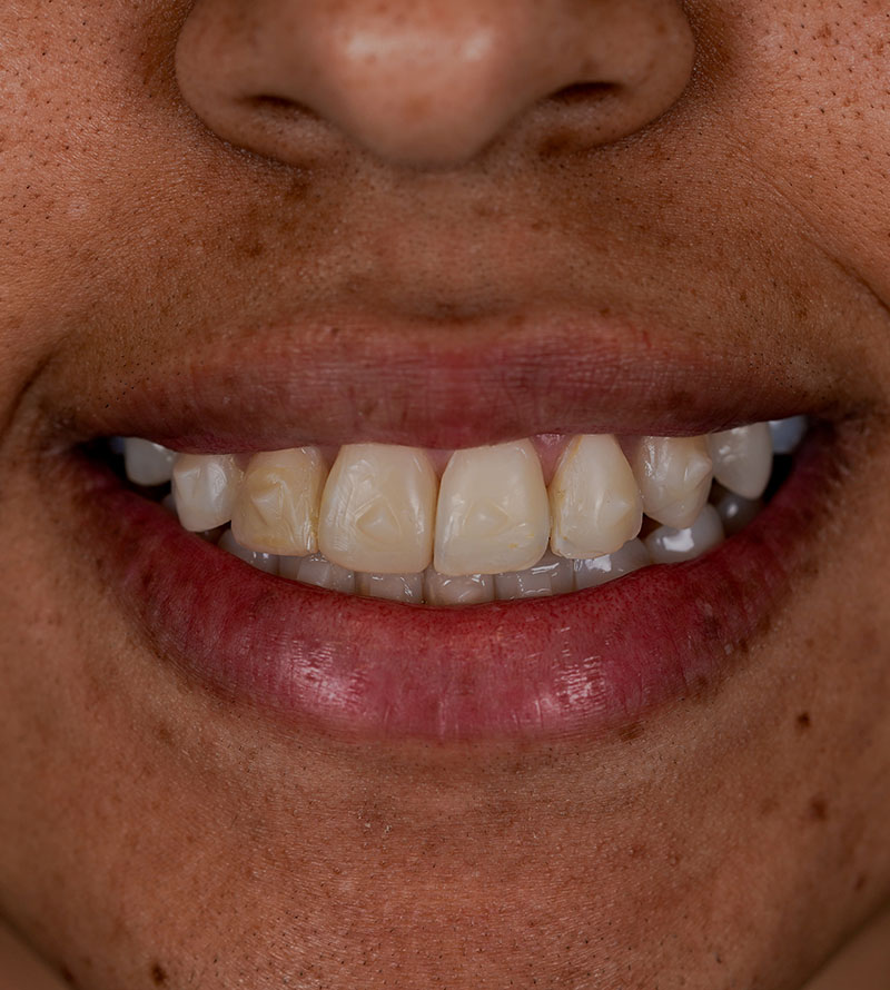 foto antes del Diseño De sonrisa con Carillas de Porcelana de Yeranis