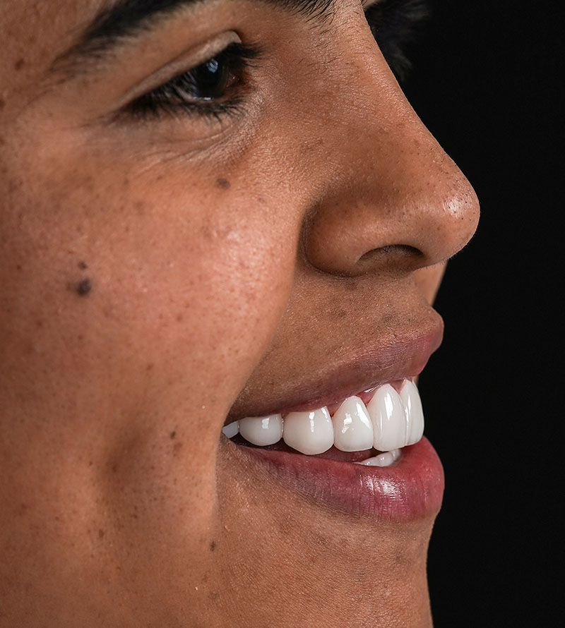 porcelain smile design at Aria