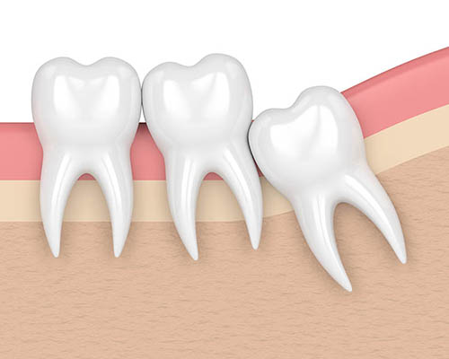 3D render de un cordal o ultimo molar que requiere extraccion