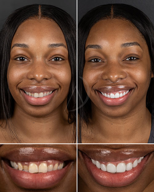 Diseño de sonrisa con carillas de resina: antes y después.