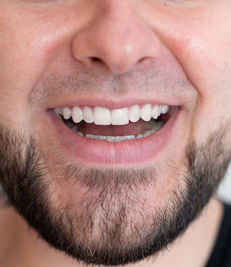 unión de dientes después