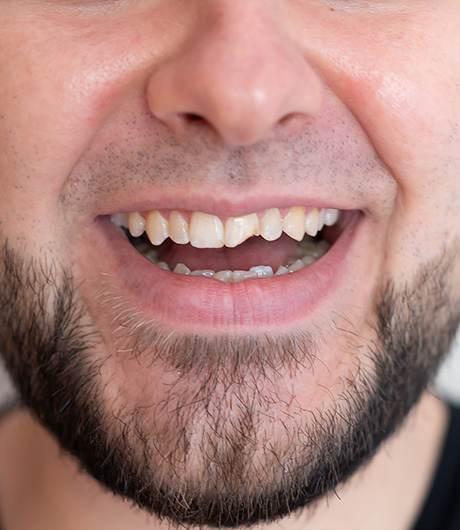 unión de dientes antes