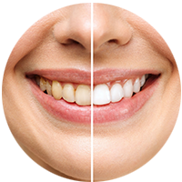 before and after teeth cleaning offer avatar